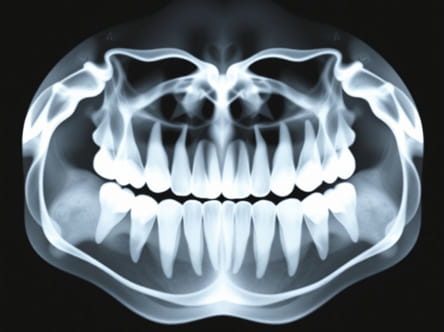 How Much Is Panoramic Dental X Ray