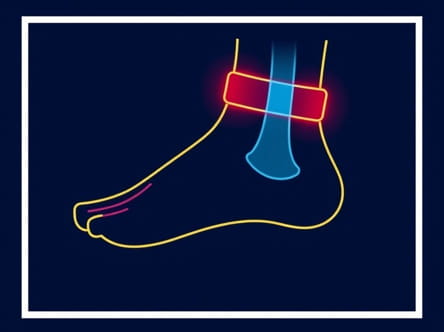 Night Brace For Plantar Fasciitis