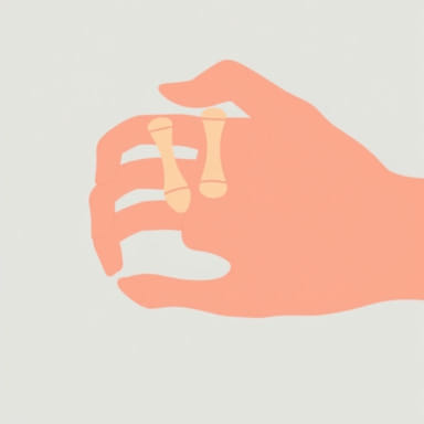 Ulnar Nerve Palsy Claw Hand