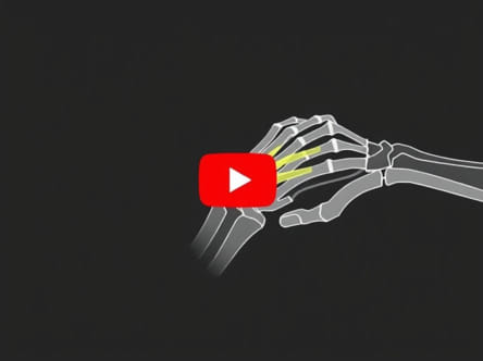 Youtube Exercises For Ulnar Nerve Entrapment