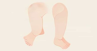 Babies Legs Look Bowed