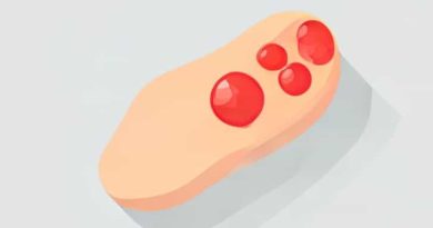 How To Treat Popped Blood Vessel In Finger