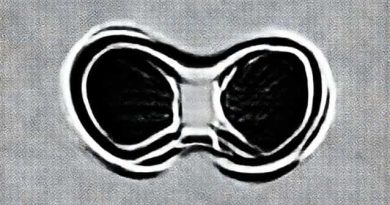 Biconcave Deformity Of The Vertebral Bodies