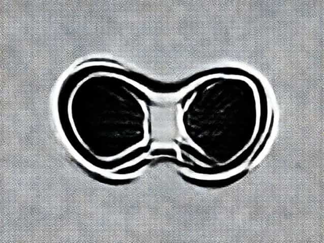 Biconcave Deformity Of The Vertebral Bodies