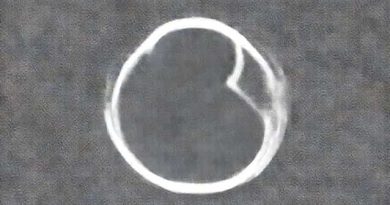 Blank And Blank Necessary For Childbearing