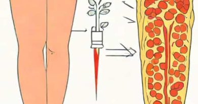 Difference Between Cellulitis And Phlebitis