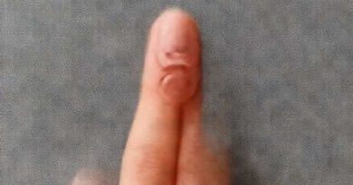 Ganglion Cyst Between Thumb And Forefinger