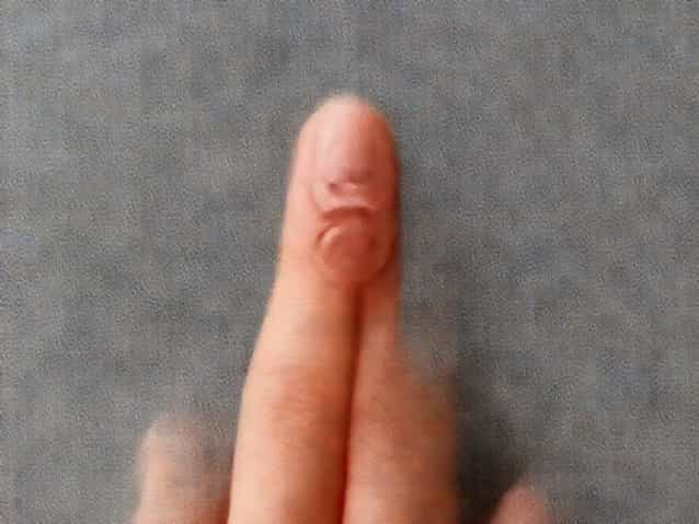 Ganglion Cyst Between Thumb And Forefinger