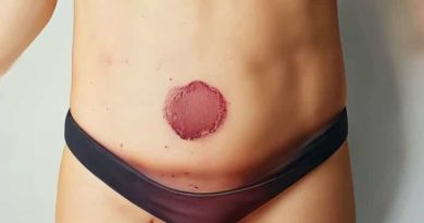 Unexplained Bruise On Left Side Of Stomach