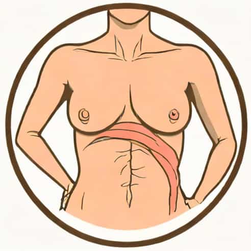 Is Mastectomy A Major Surgery