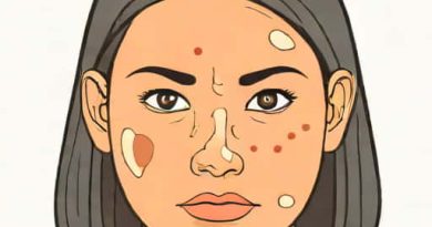 Acne And Seborrhea Are Caused By Problems With